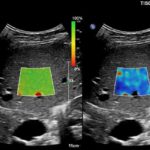 Liver Shear-Wave Elastography is now available at North Queensland X-Ray Services and is bulk-billed image